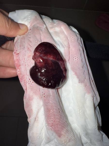 Warning photo! Is this a miscarriage or a big blood clot