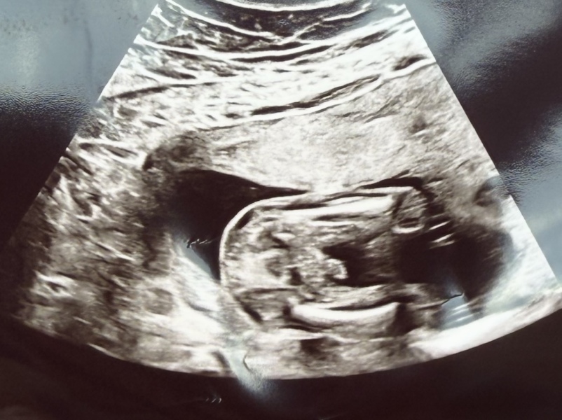 18 week scan gender