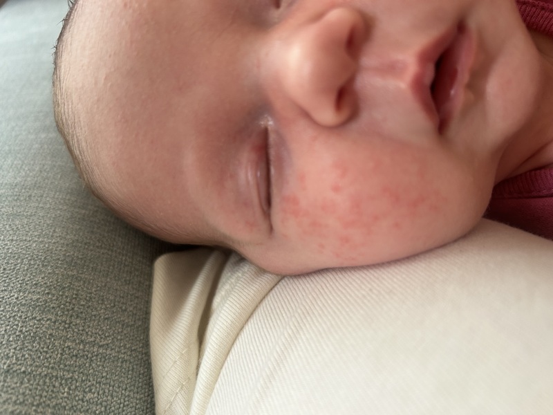 Is this baby acne?
