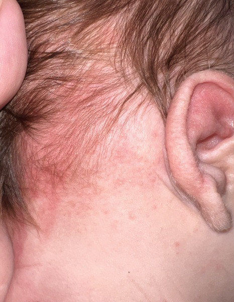 Rash/spots only on babies head and face