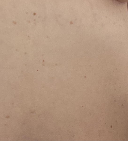 loads and loads of tiny flat brown skin tags on abdomen/under bra area how to get rid?