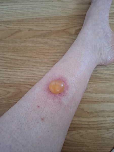 Do you want to see something *disgusting* on my leg?