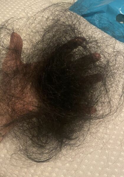 Hair loss on Mounjaro