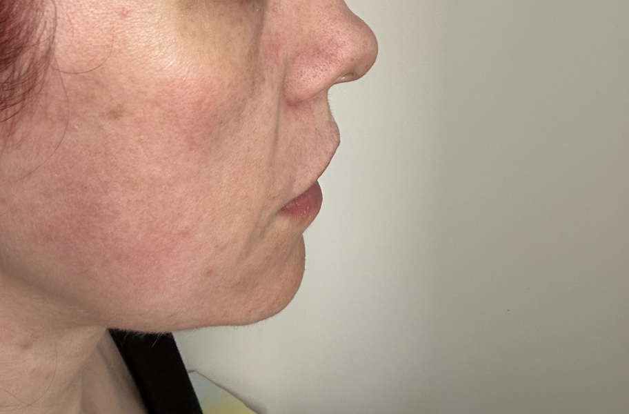 One sided rosacea?