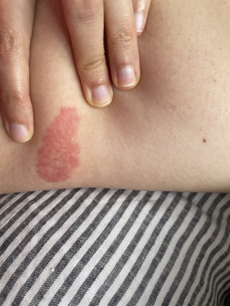 Bee sting - normal reaction? (Pic)