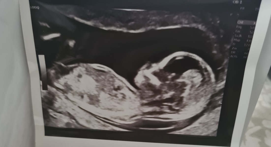 What gender do you think my baby is? NUB THEORY?