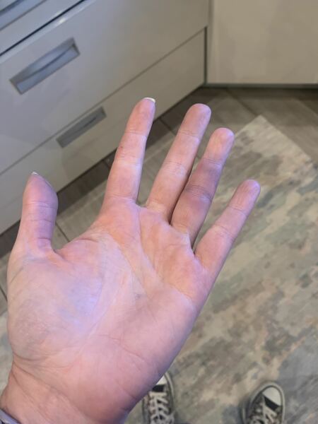 Random bruise - burst ganglion!??  Finger numb..