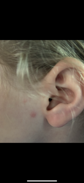 To ask if this looks like the start of chicken pox?