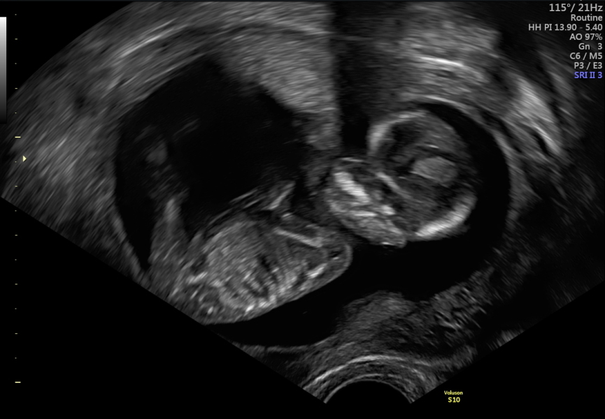 Poor experience at 12 week nhs scan