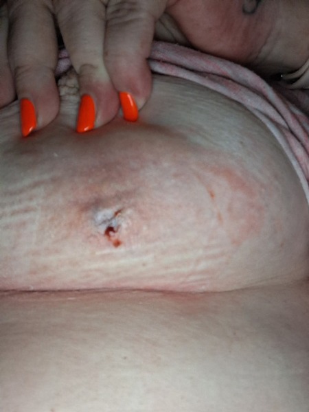Lump on breast? Pics attached