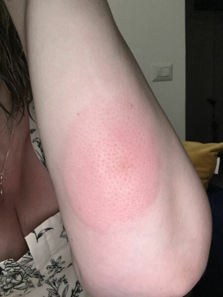 Mosquito bite prevention