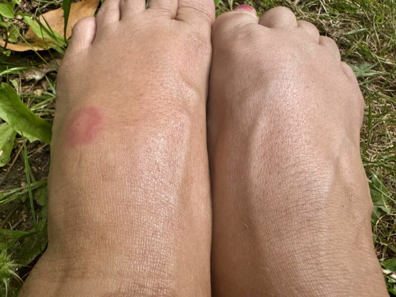 Does this horsefly bite look infected?