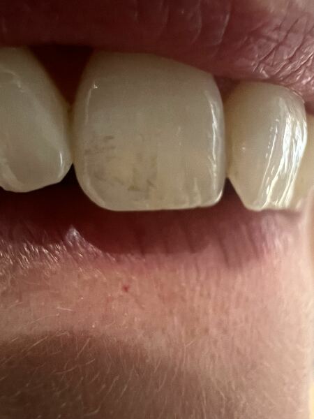 Teeth - discolouration? Any dental nurses/dentists on here?