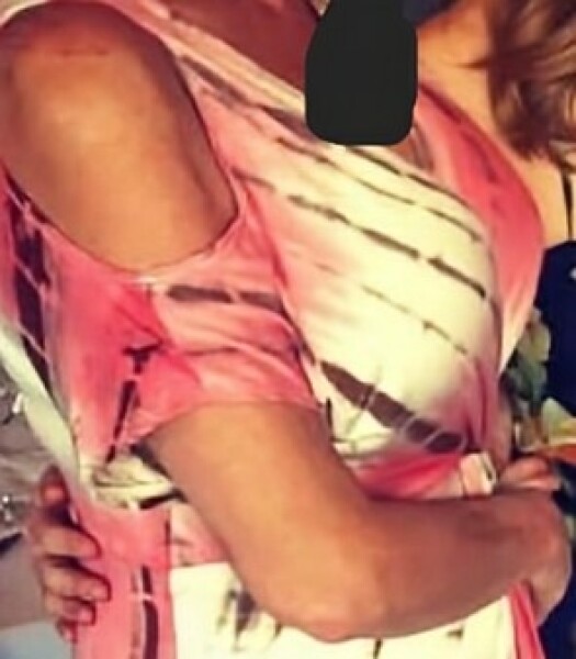 Do I need an antibiotic?