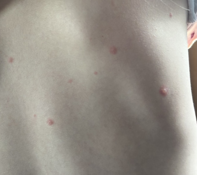 Is this chicken pox??