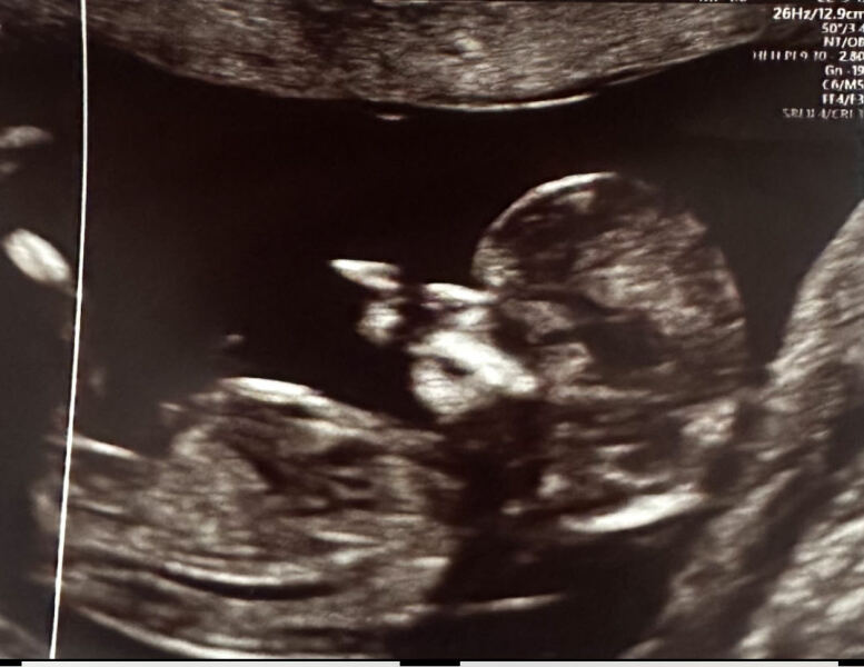 Nub or skull theory - gender guesses