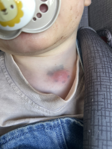DS 16 months has an infected cyst - what else can I do? (Picture attached)