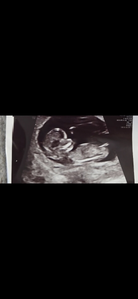 Boy or girl based on nub theory
