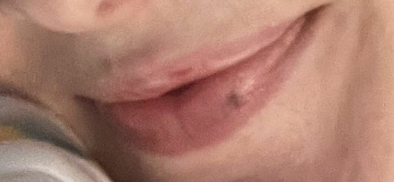 How to heal bruise on lip that’s been there years? Pics
