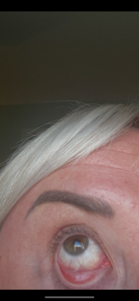 To think that this is jaundice in eye? Photo attached