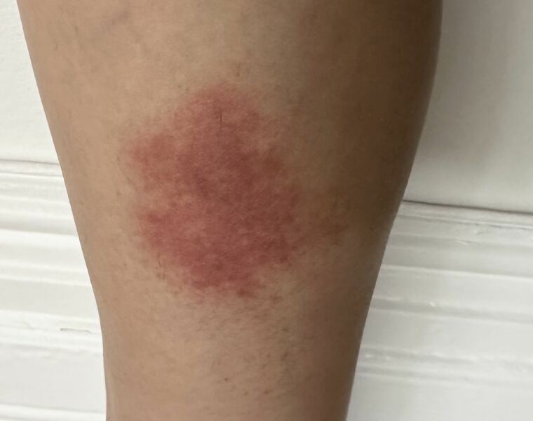 Is this a bullseye rash?