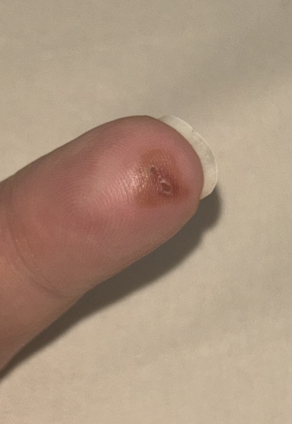 Burn on fingertip