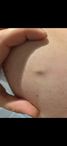 Hard lump under skin ?