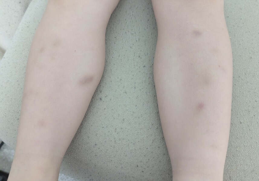Bruises on 5 year old legs