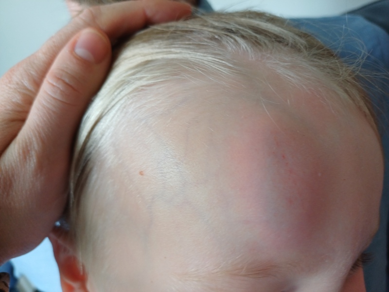 A&E 3yo head injury
