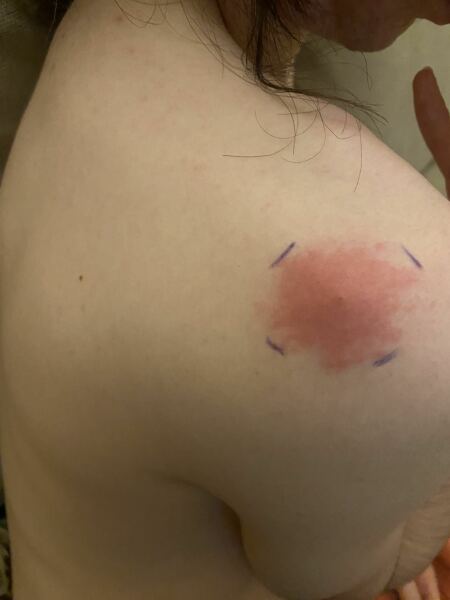 What could have caused this bite?  What to do?