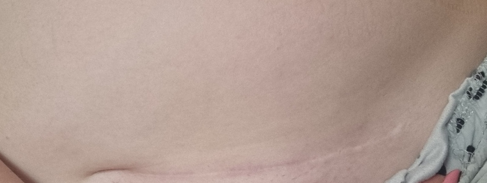 C section scar - indent - advice please