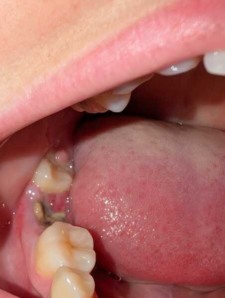Tooth extraction healing