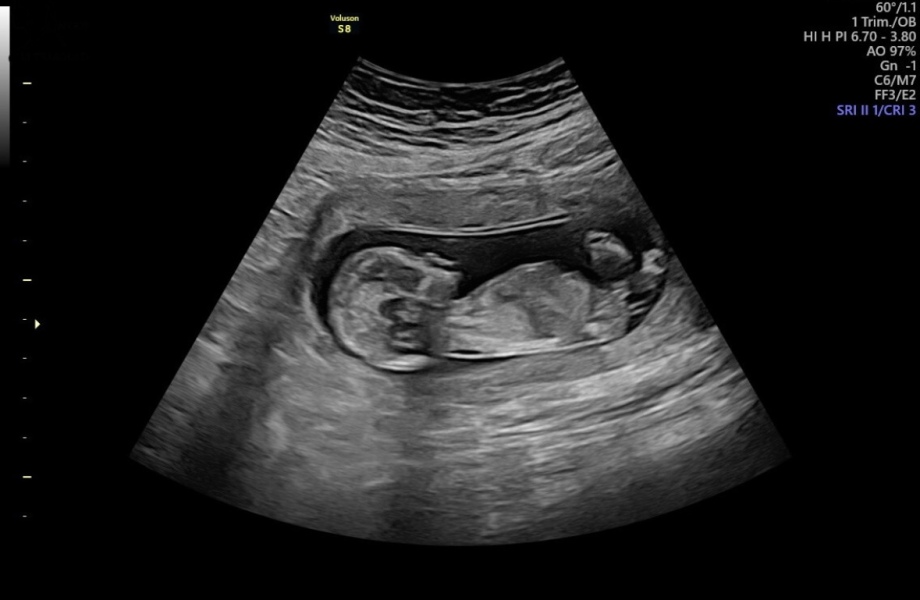 13.3 scan today 🤍