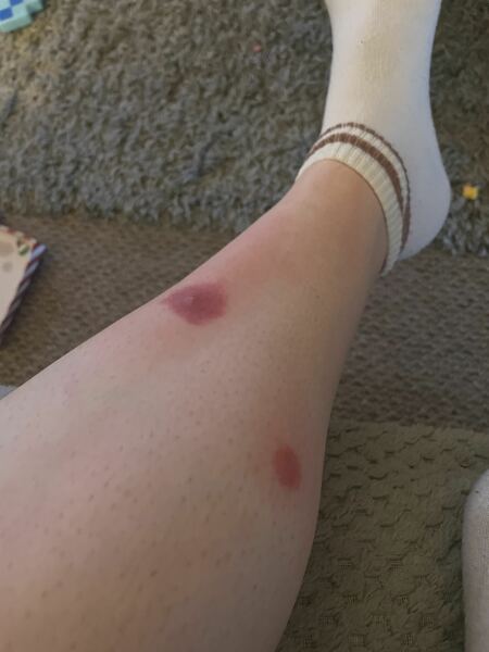 Identify my bites!