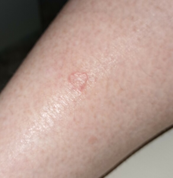 What the heck is this circular rash type thing on my back?