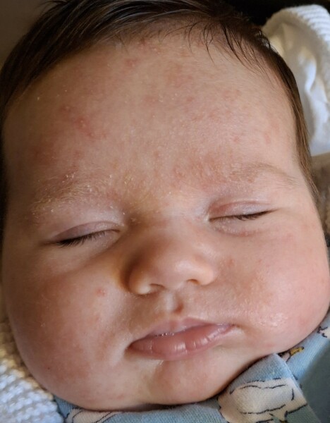 Rash/spots only on babies head and face