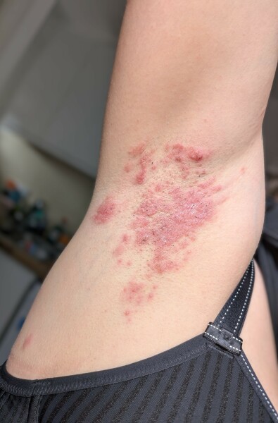 Rapidly spreading skin infection under arm. Help. (Photo warning)