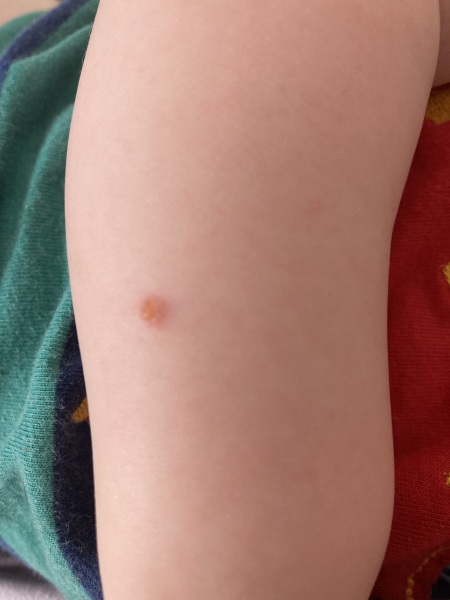 Is this chicken pox? An insect bite? Something else?