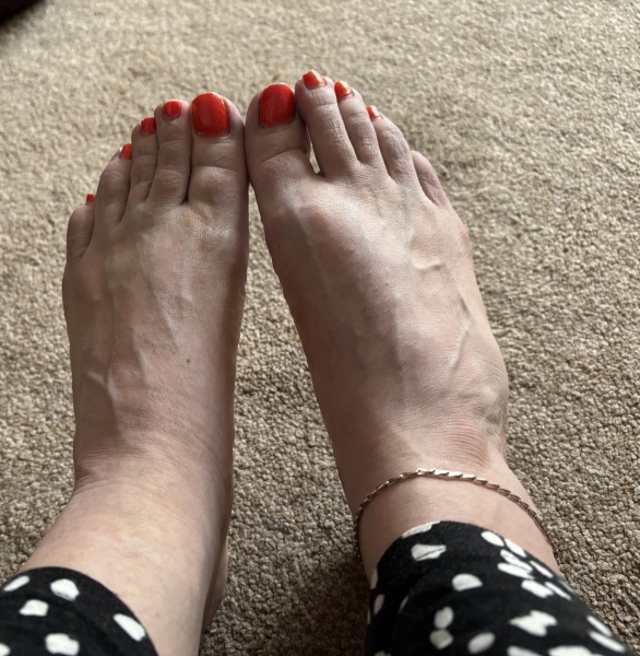 Foot injury - not sure if to get it checked (photo in comments)