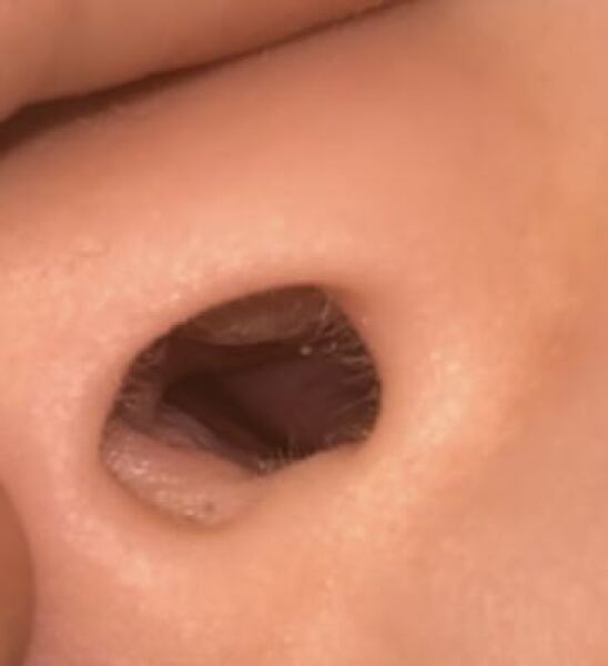 Nasal Polyps - 3 year old?