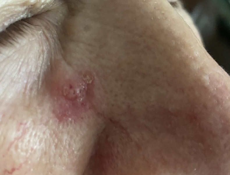What is this sore on my Mum's face?
