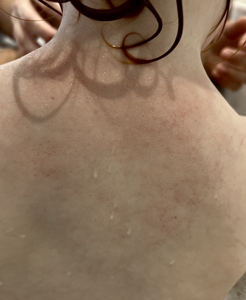 Help please - persistent low grade fevers and Petechiae two year old