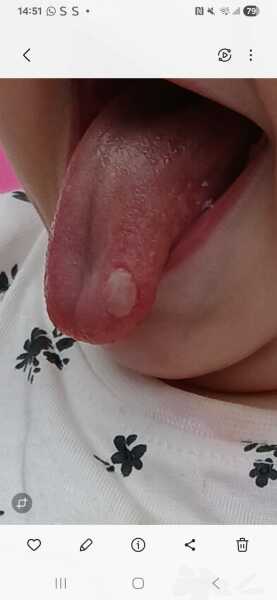 Canker sore? Mouth injury?