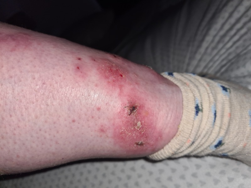 Burning and painful skin.