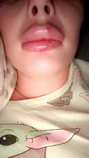 Help! 0.8ml of lip fillers supposed to be this swollen?