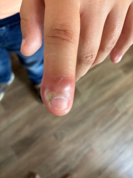 Finger abcess