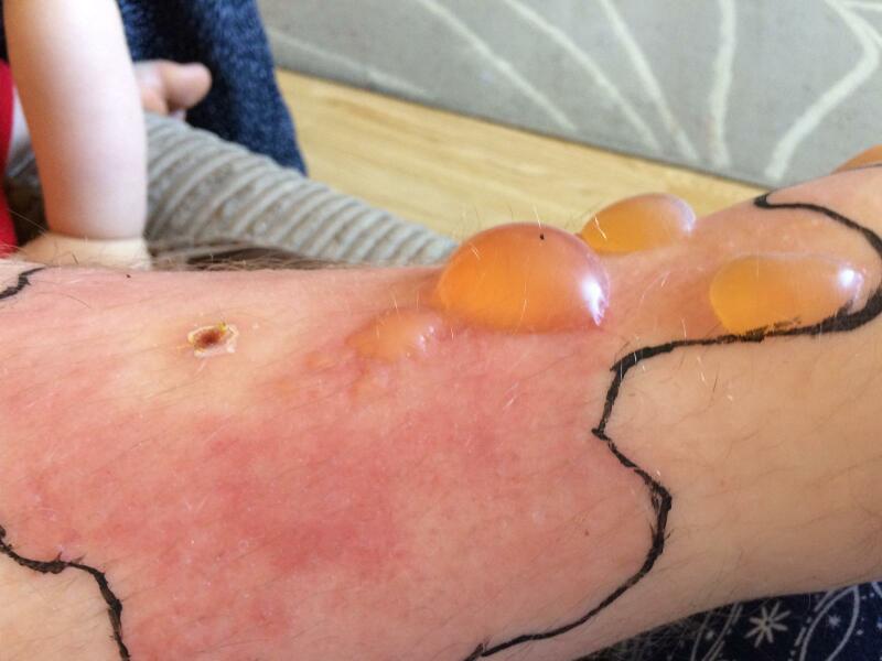 Do you want to see something *disgusting* on my leg?