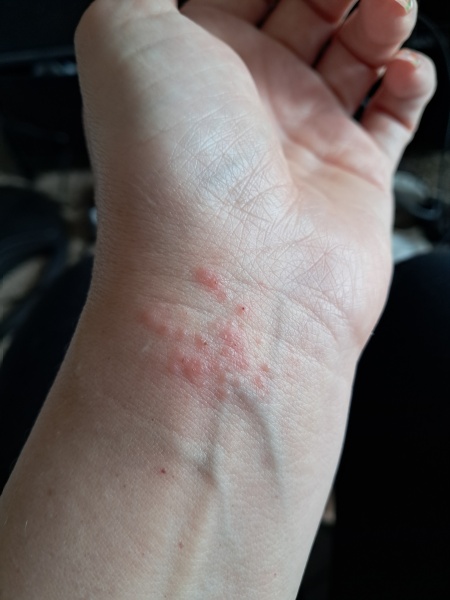 Contact Dermatitis? Please help!