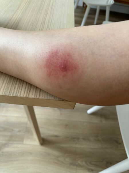 Is this a bullseye rash?