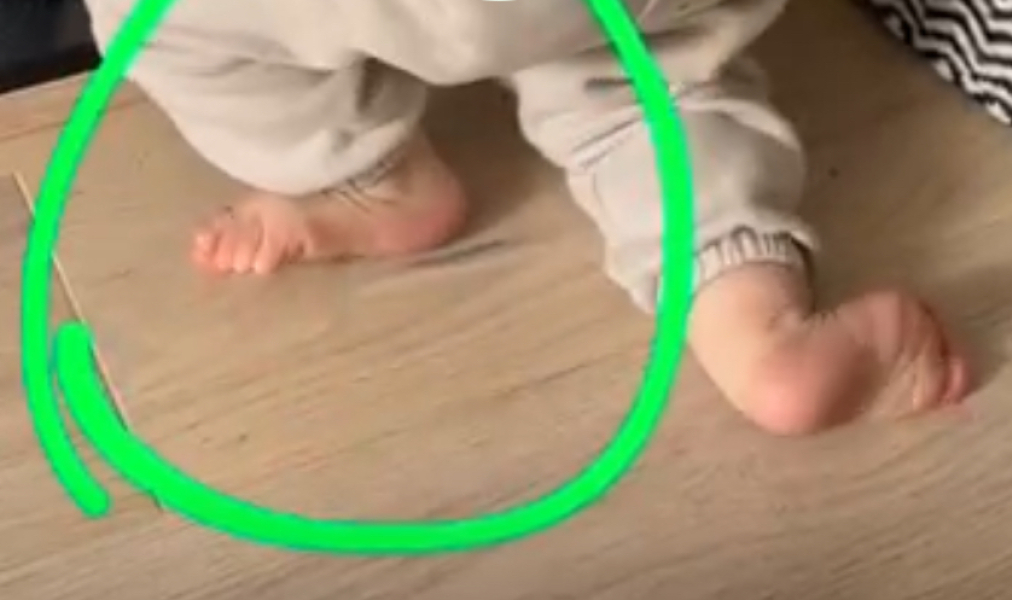 1yo using side of foot to pull himself up - physio?